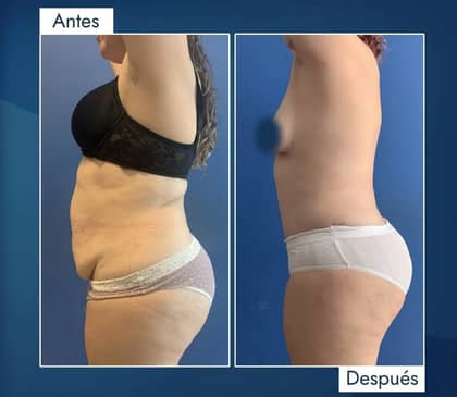 Slider image (5) Dr. Jose E. Telich - Plastic Surgeon